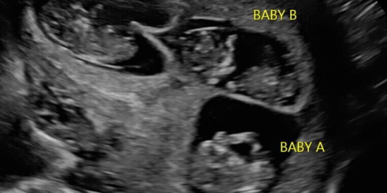 An Overview of Embryo Reduction