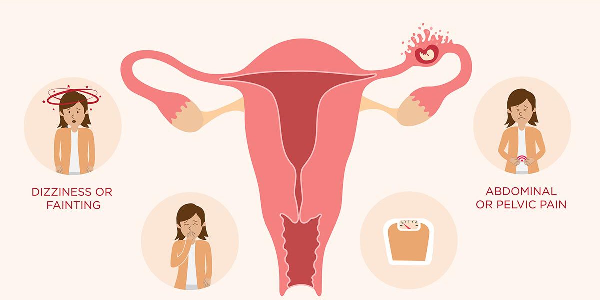 Ectopic pregnancy symptoms