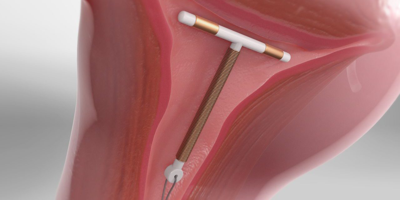 Understanding Intrauterine Device