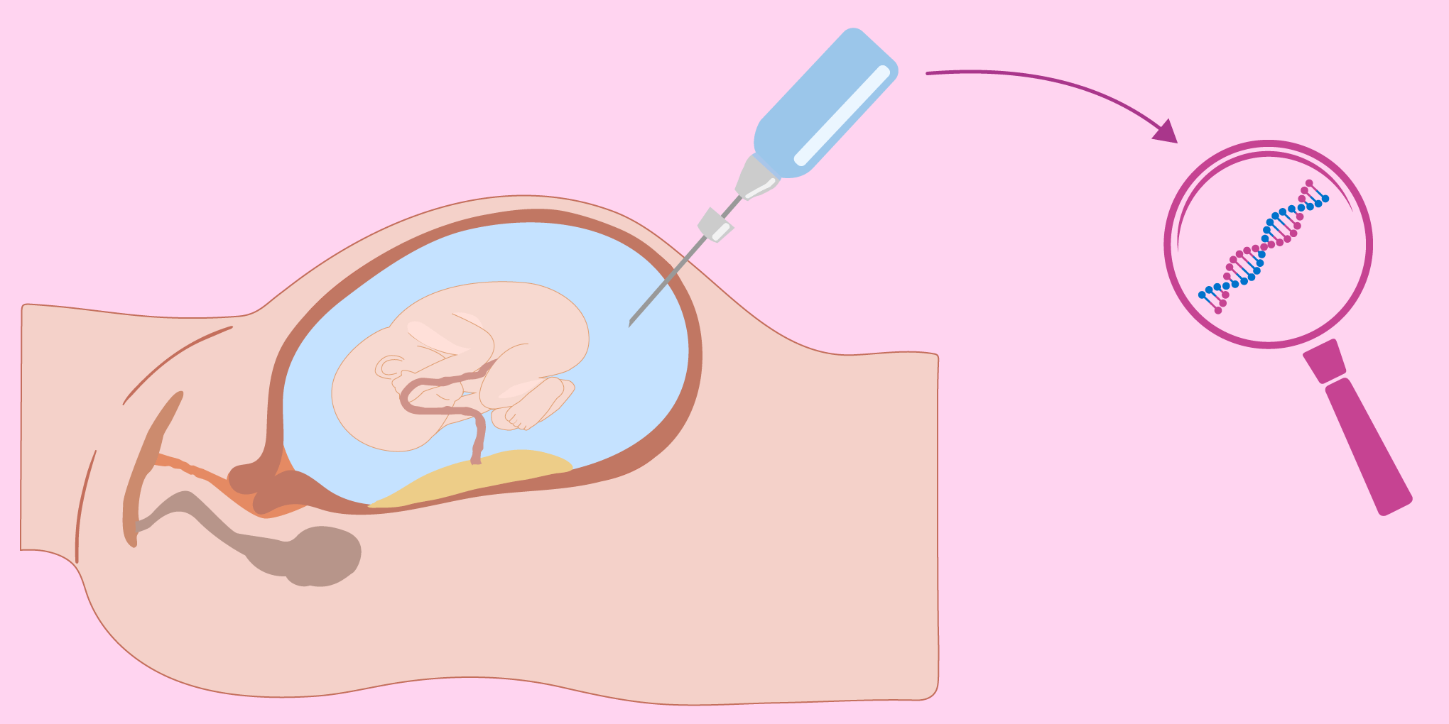 Understanding amniosentesis